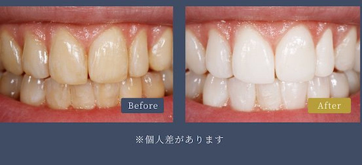 ビューティーコート施術後